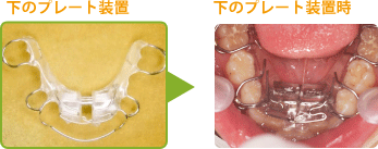 下プレートの図解